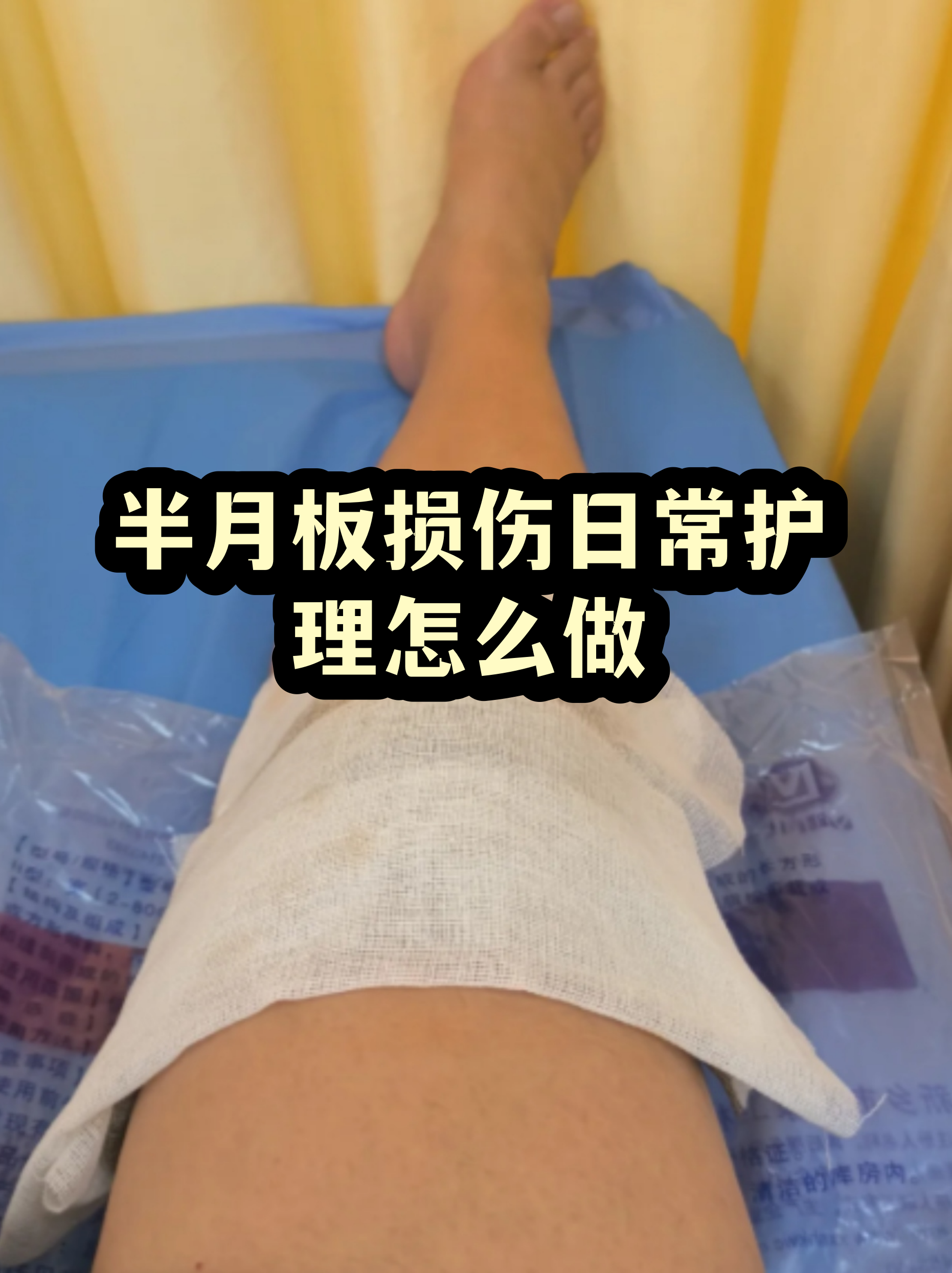 外侧半月板损伤怎么办(外侧半月板损伤如何恢复)