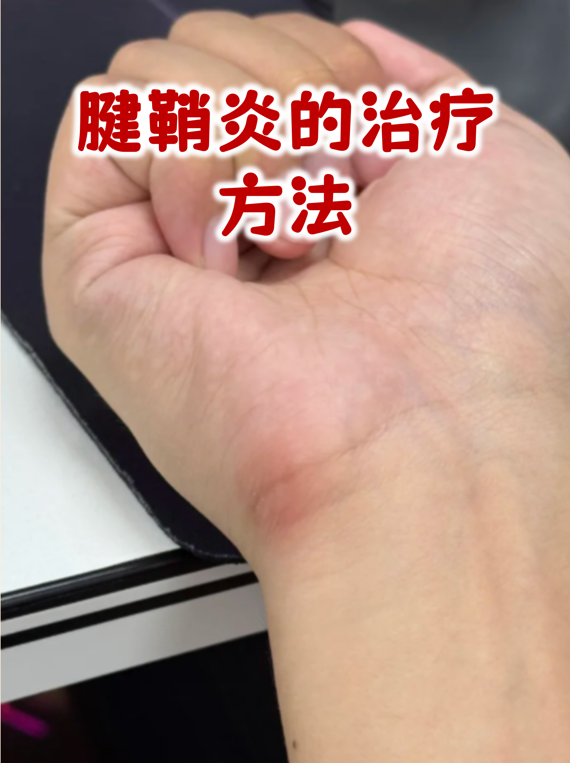 肌腱炎怎么治疗(冈上肌肌腱炎怎么治疗) 肌腱炎怎么治疗(冈上肌肌腱炎怎么治疗)