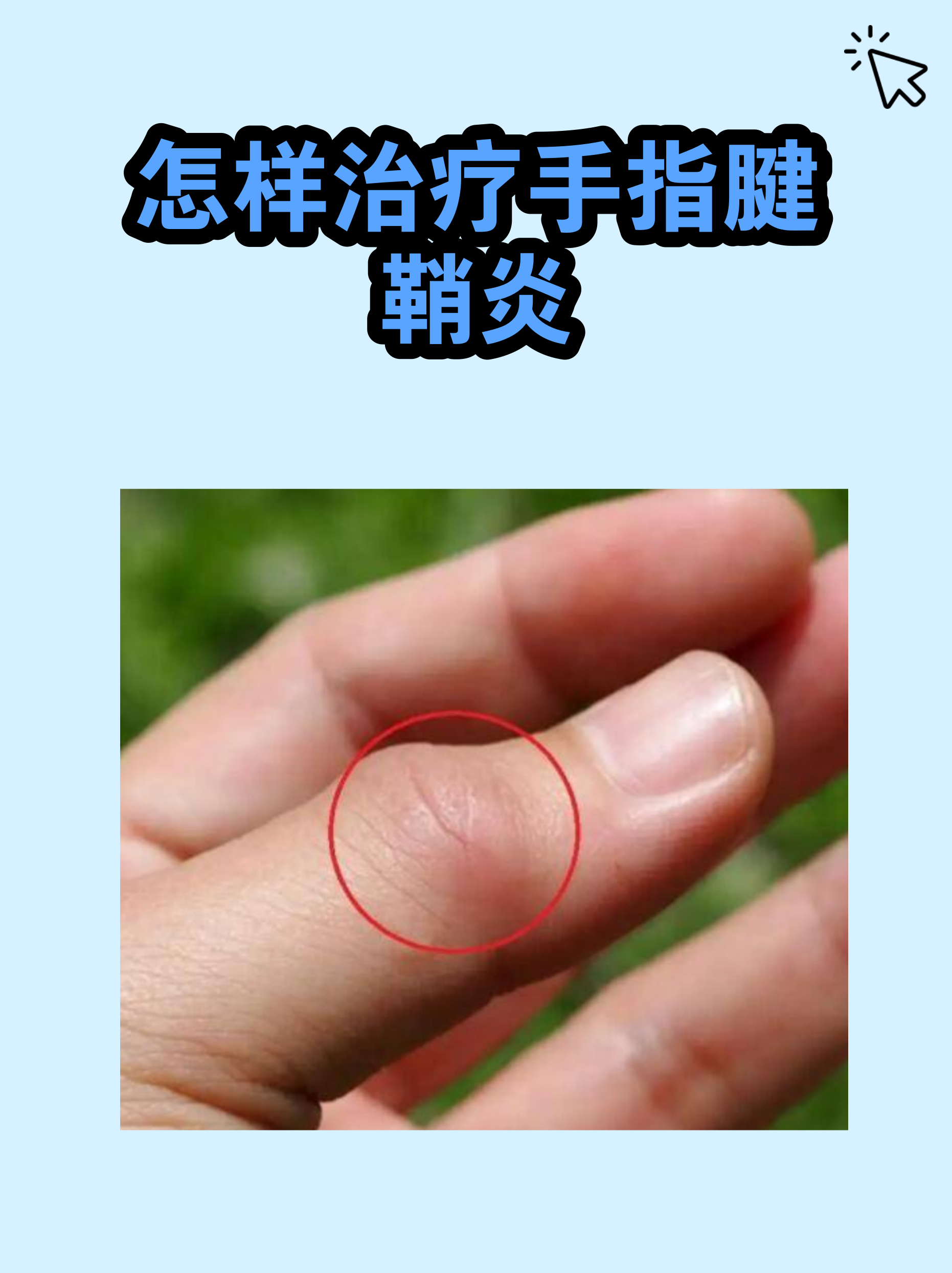 手指腱鞘炎怎么治(拇指腱鞘炎怎样治疗) 手指腱鞘炎怎么治(拇指腱鞘炎怎样治疗)