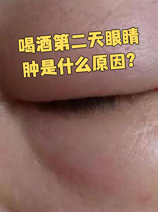 酒精入眼睛怎么办(酒精进入眼睛如何处理) 酒精入眼睛怎么办(酒精进入眼睛如何处理)