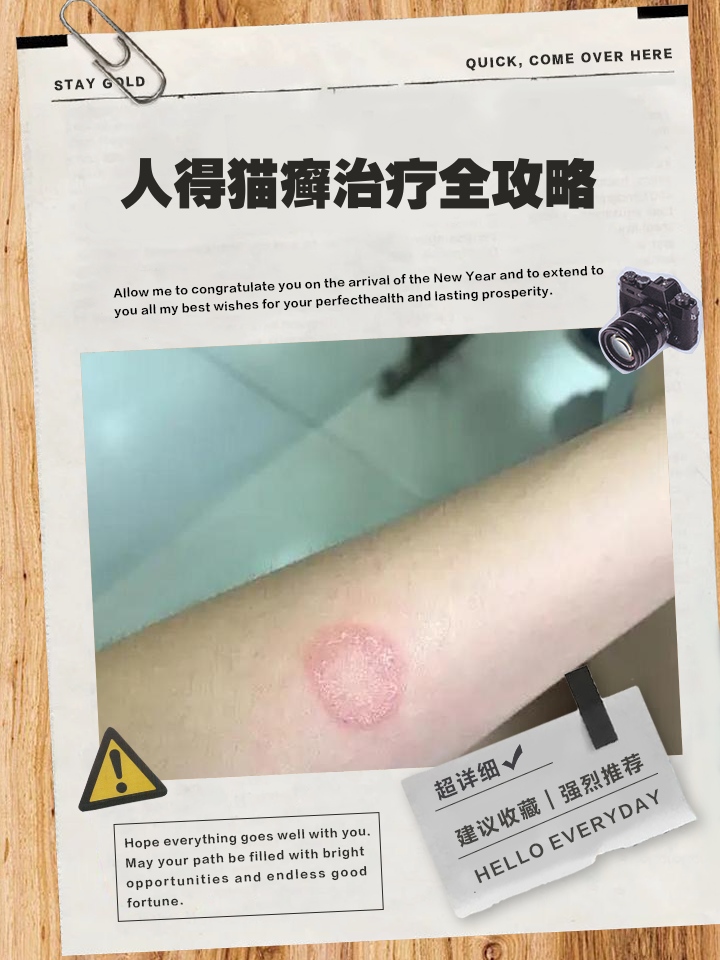 人得猫癣一般会长在什么位置(人得猫癣各个阶段图片长什么样)