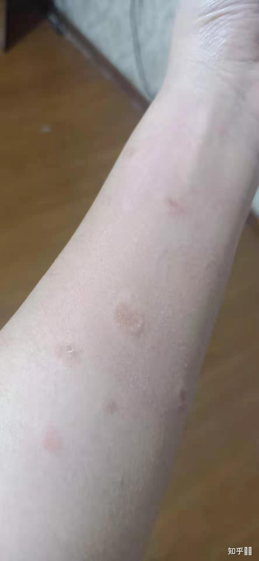 人得了猫藓初期的样子(人得猫癣早期皮肤有什么特征)