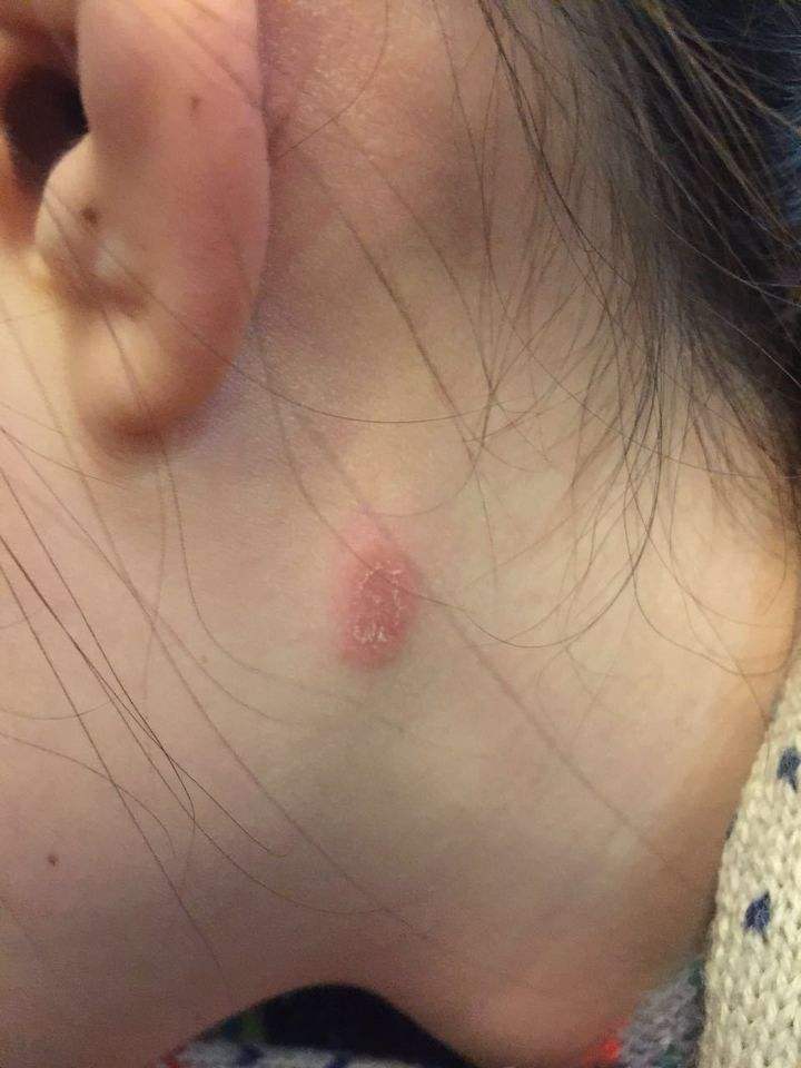 人得了猫藓初期的样子(人得猫癣早期皮肤有什么特征) 人得了猫藓初期的样子(人得猫癣早期皮肤有什么特征)