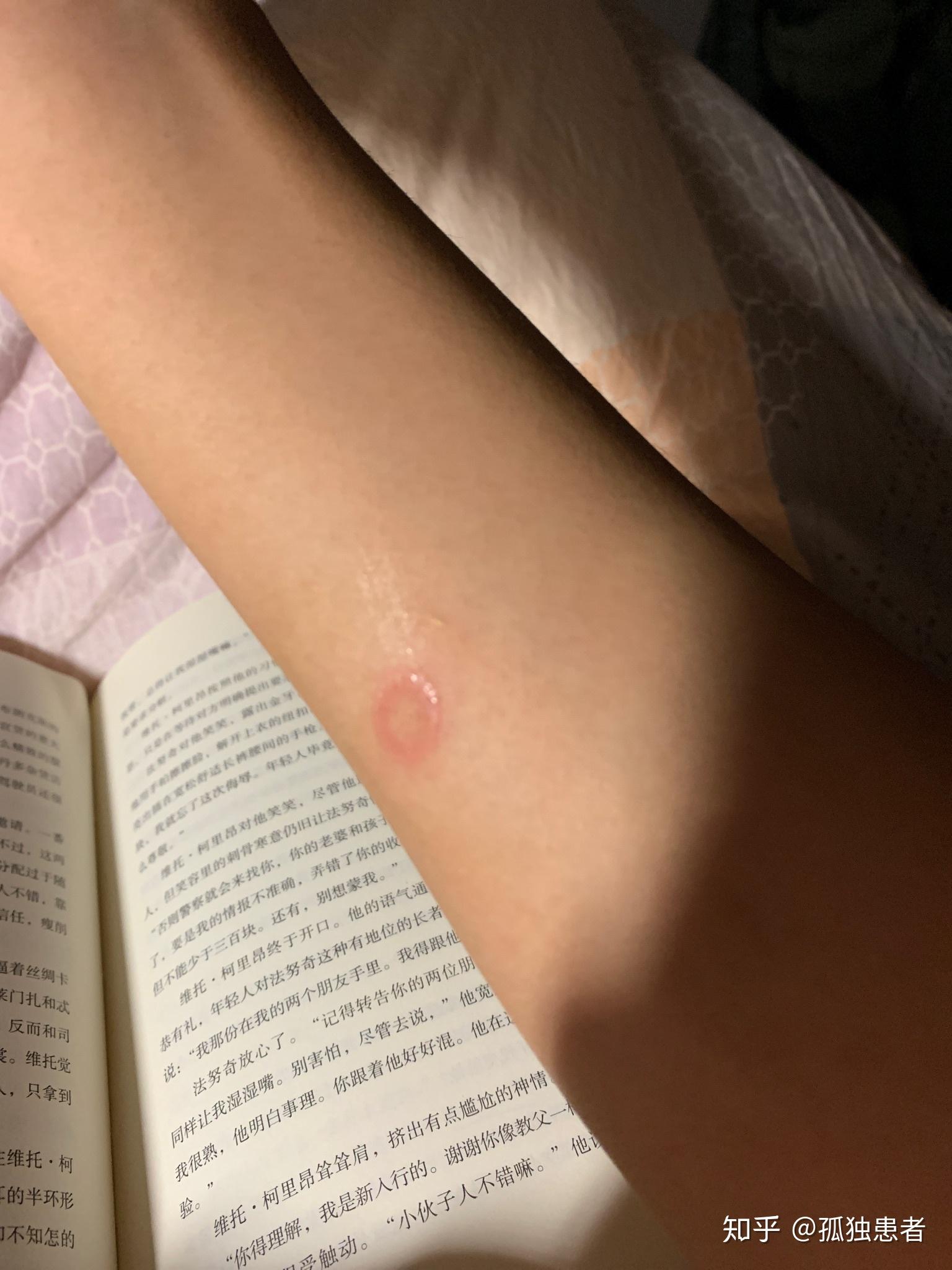 人传染猫癣初期症状图(人传染了猫藓是什么样的图片)