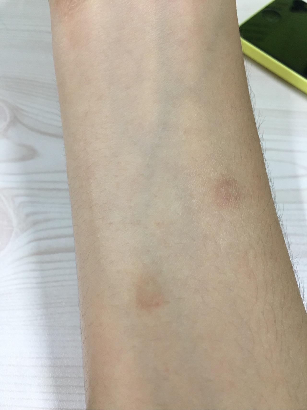 人传染猫癣初期症状图(人传染了猫藓是什么样的图片) 人传染猫癣初期症状图(人传染了猫藓是什么样的图片)