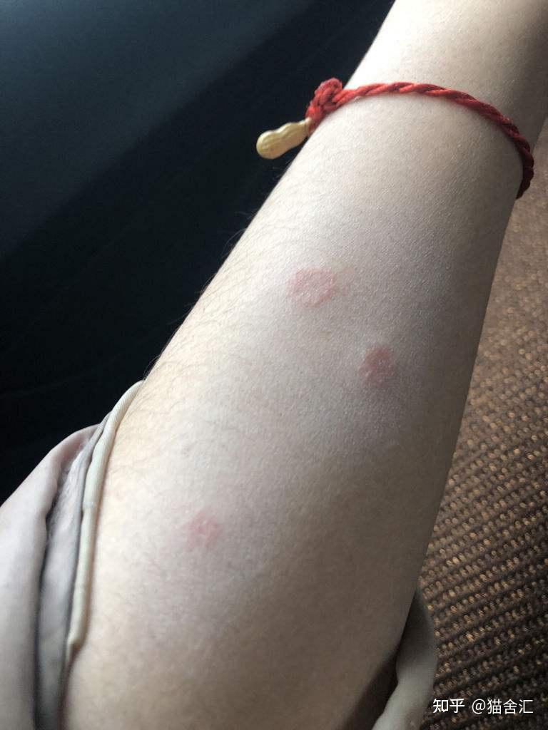 猫癣是什么样子的图片(猫癣是什么样子的图片 初期) 猫癣是什么样子的图片(猫癣是什么样子的图片 初期)