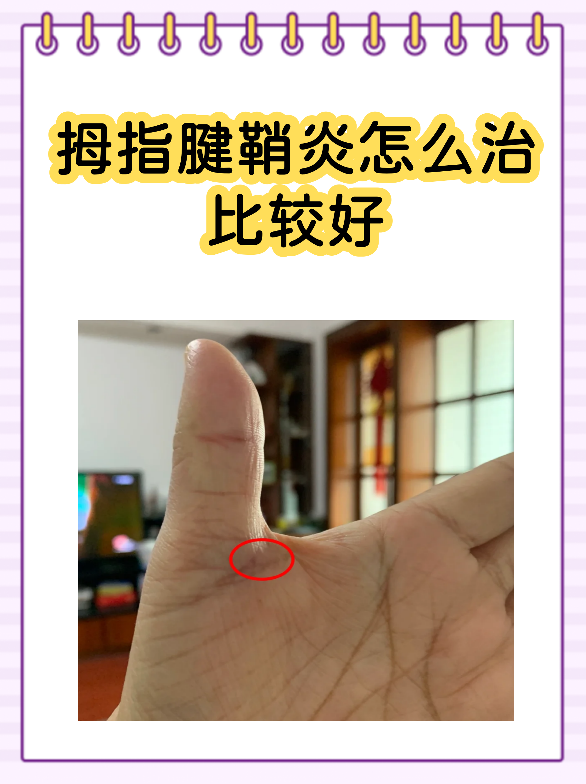 手指腱鞘炎怎么治疗(狭窄性手指腱鞘炎怎么治疗) 手指腱鞘炎怎么治疗(狭窄性手指腱鞘炎怎么治疗)