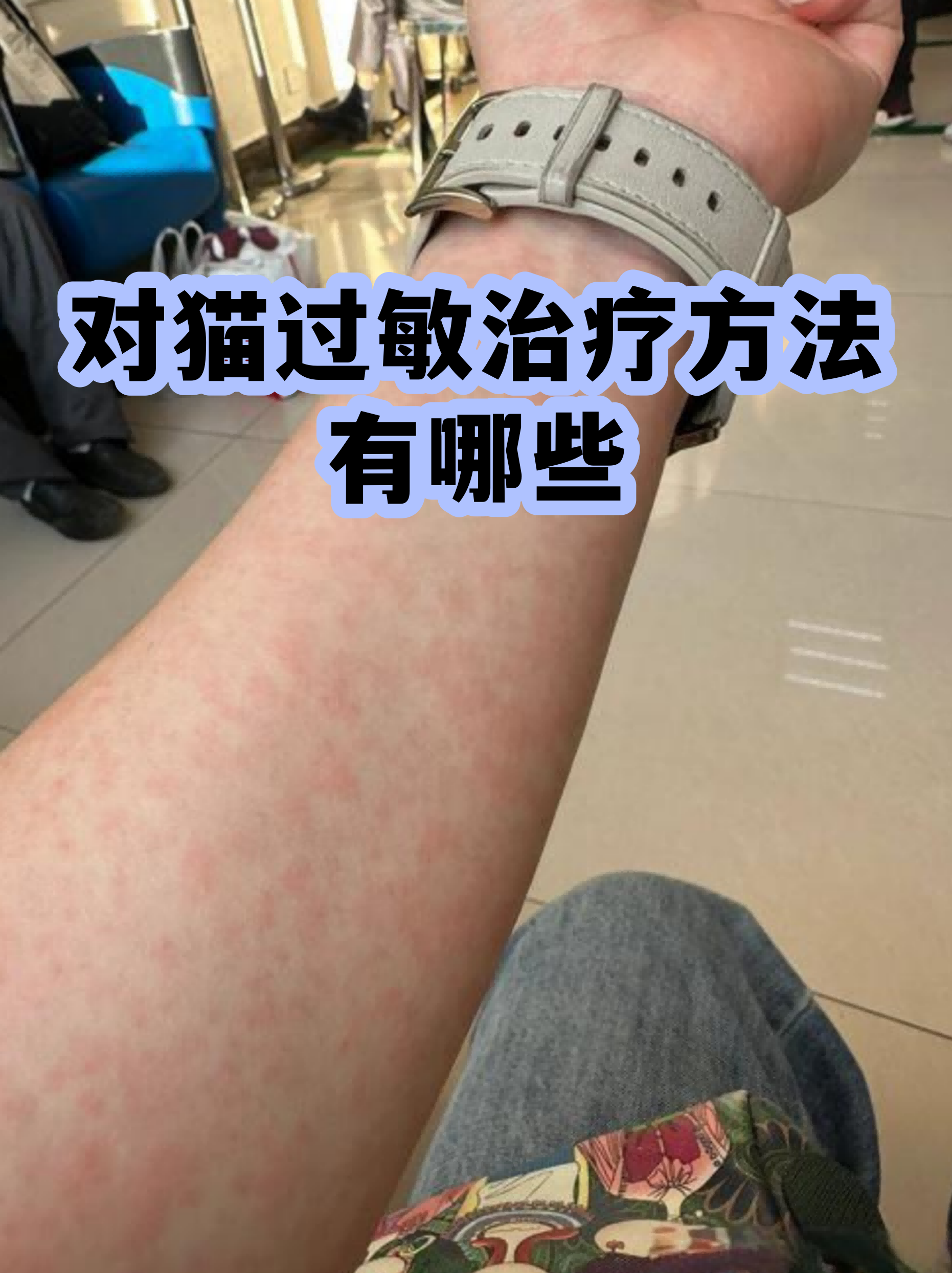 猫过敏有什么症状(猫过敏有什么症状图片)