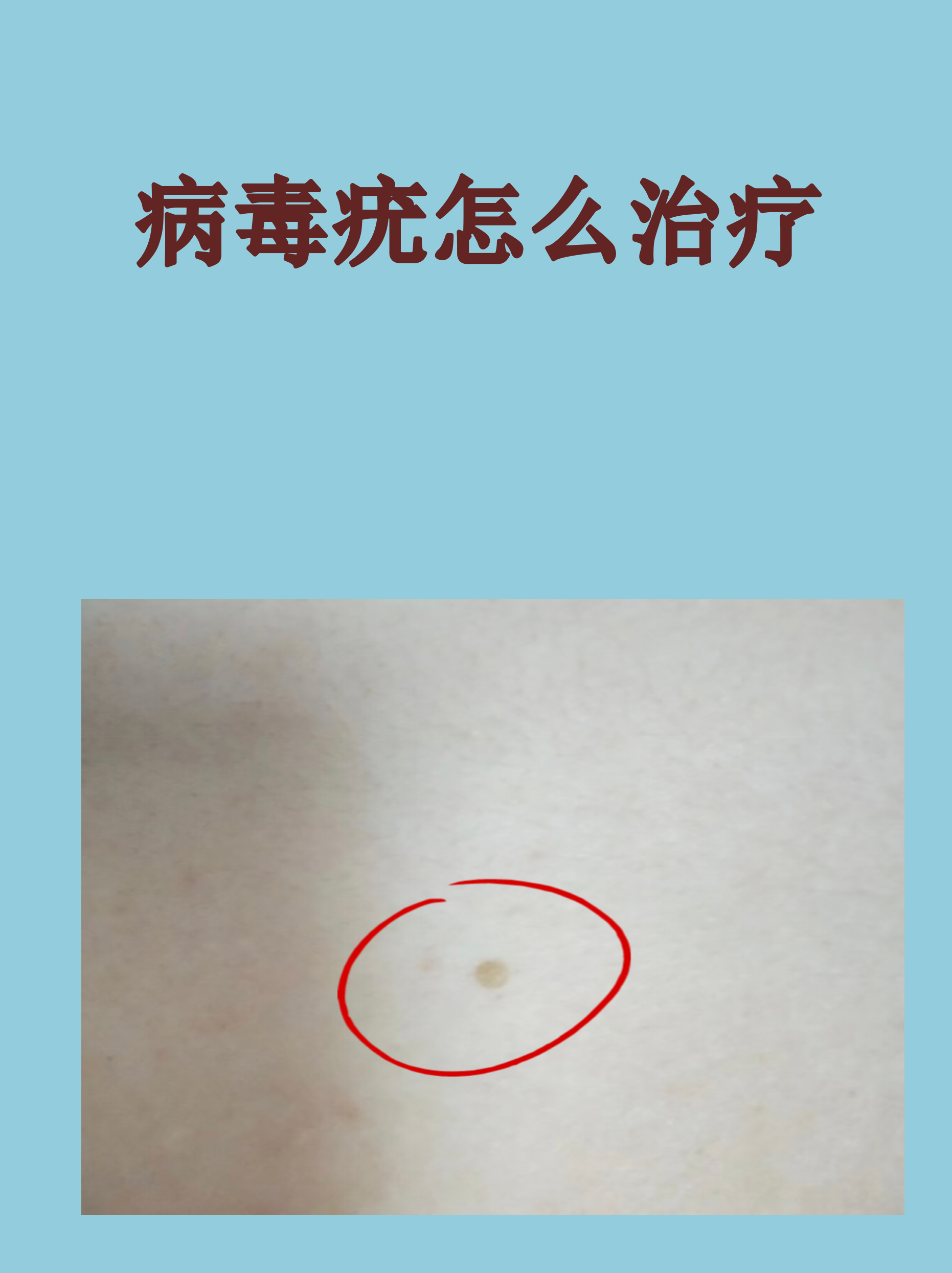 赘疣怎么读(赘疣怎么读?)